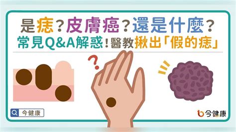 長痣原因|是痣？皮膚癌？還是什麼？常見Q&A解惑！醫教揪出「。